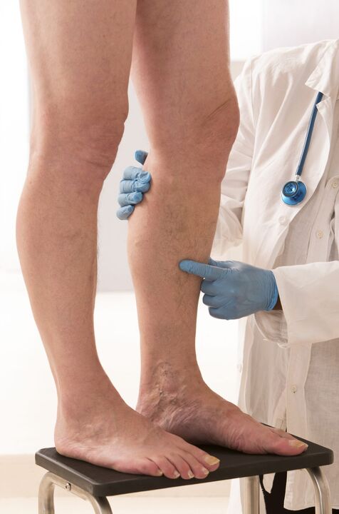 Vericosis Τι είναι